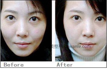 <a href='/tag_boniaosuanzhushe37.html'>玻尿酸注射</a>丰面颊