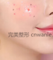 玻尿酸丰面颊其原理是怎样的