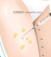 腿部吸脂后会反弹吗?对于所有的女性来说,粗壮的大腿