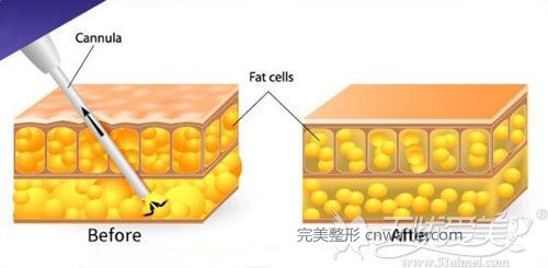 吸脂手术原理