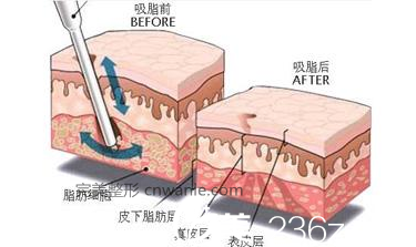 吸脂手术原理