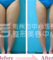 大腿吸脂术会不会反弹呢?