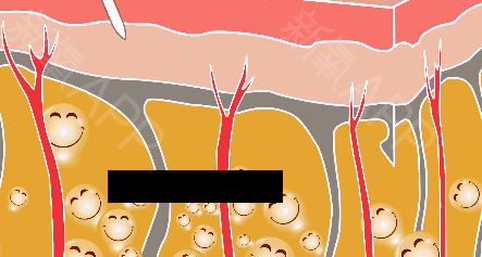 腹部吸脂