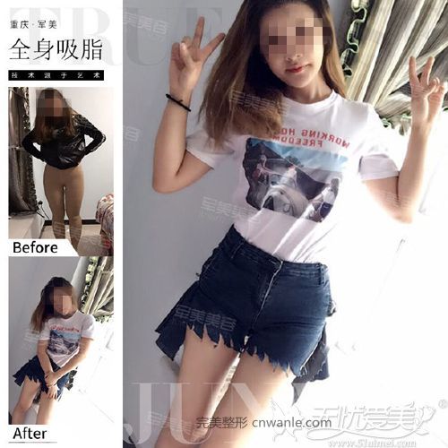 大腿吸脂前后对比效果