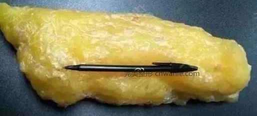 腹部吸脂