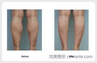 瘦小腿.jpg
