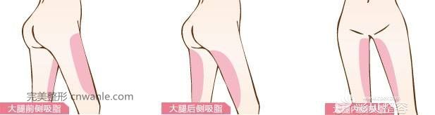 大腿吸脂术部位展示 大腿吸脂术部位展示