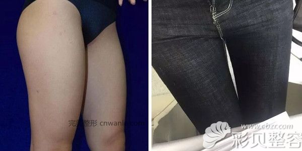 分享我找北京美莱刘金华做<a href='/tag_datuixizhi10.html'>大腿吸脂</a>术后80天效果对比图 分享我找北京美莱刘金华做<a href='/tag_datuixizhishu.html'>大腿吸脂术</a>后80天效果对比图