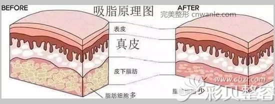 吸脂原理图