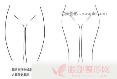 大腿吸脂术后暴饮暴食体重还是会反弹但只是脂肪细胞体积增大了