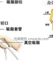 双侧大腿水动力环吸脂 夏日秀出瘦长直腿(含8个部位)