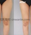 大腿吸脂 不反弹的瘦腿方法