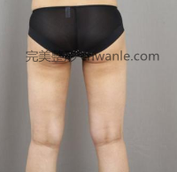 什么是<a href='/tag_datui21.html'>大腿</a><a href='/tag_xizhijianfei25.html'>吸脂减肥</a>手术?