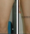 嘉兴大腿部吸脂后会反弹吗