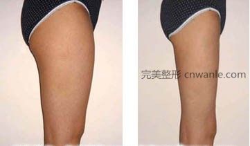 腿部吸脂<a href='/tag_qianhouduibi.html'>前后对比</a>图