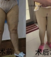 其实对于现在的吸脂技术来说,大腿吸脂后是不会出现反