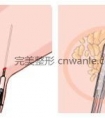 腿部吸脂