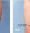 大腿吸脂会反弹吗?