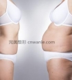 大腿内侧抽脂会留疤吗 大腿抽脂反弹吗
