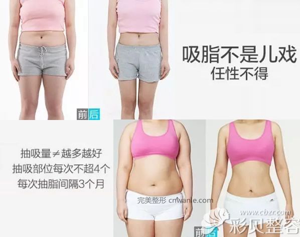 北京海医悦美大腿吸脂和腰腹吸脂案例