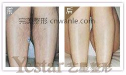 成都艺星激光脱腿毛会痛吗