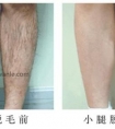 冰点脱毛的优势 (3)