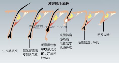 冰点无痛 脱毛仪脱毛原理