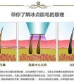 冰点脱毛四大优势是什么