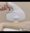 冰点脱毛的操作步骤及优势