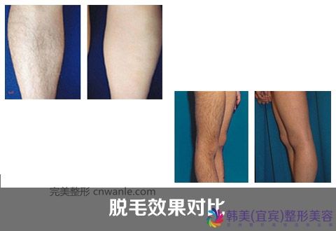 冰点脱毛优势是什么