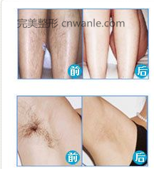 脱毛<a href='/tag_qianhouduibi.html'>前后对比</a>照