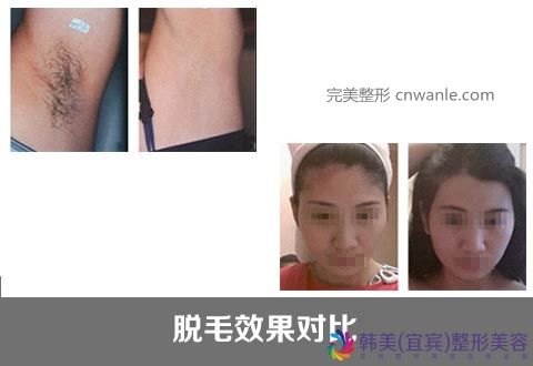 冰点脱毛的优势有哪些?冰点脱毛 冰点脱毛的优势有哪些?冰点脱毛