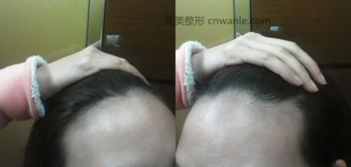 女生发际线后移