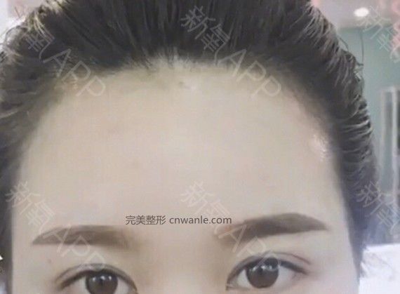 半永久纹发际线
