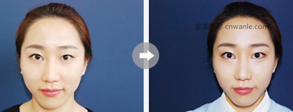 发际线移植案例对图