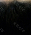 杭州半永久纹发际线好不好