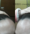 关于发际线后移,是毛发移植好还是纹发际线好?