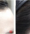 纹发际线多少钱 效果怎么样