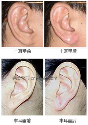 丰耳垂,对比图,吉林市好的整形医院