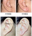 吉林市玻尿酸丰耳垂的特色