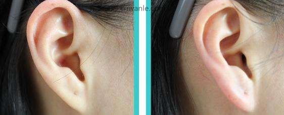 注射丰耳垂效果