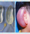 耳廓再造手术前后的护理