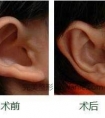 全耳再造手术护理常规