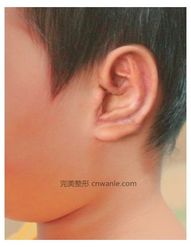 肋软骨耳再造二期手术