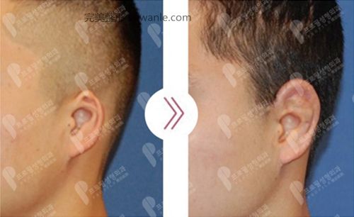 韩国profile普罗菲耳整形医院外耳廓畸形矫正案例
