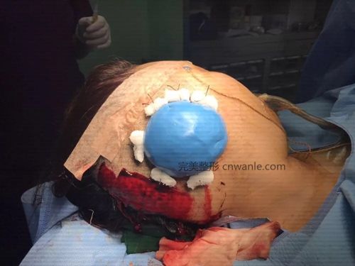 韩国profile普罗菲耳整形医院耳部再造术后