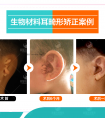 小耳再造手术后效果
