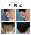 余文林:耳再造手术后的再造的耳朵会变形吗?