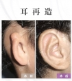 小耳畸形耳再造手术后为什么会肿胀? (2)