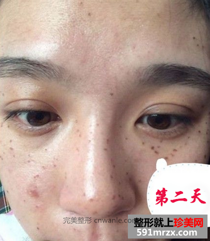 激光去斑效果如何 激光祛斑前后对比图